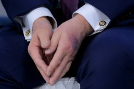 A bruise is seen on the back of U.S. President Donald Trump's hand during a signing ceremony for his “Board of Peace” at the World Economic Forum in Davos, Switzerland, on Jan. 22.